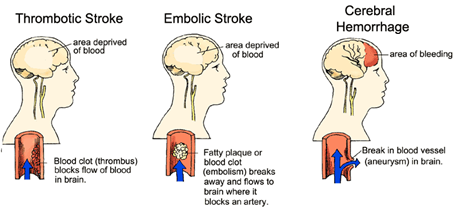 types-of-strokes1